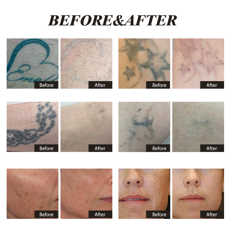 New Version Picoking upgrade system laser tattoo removal machine with 4 working model increasing high efficiency Remove pigments shorter recovery time no downtime - Image 4